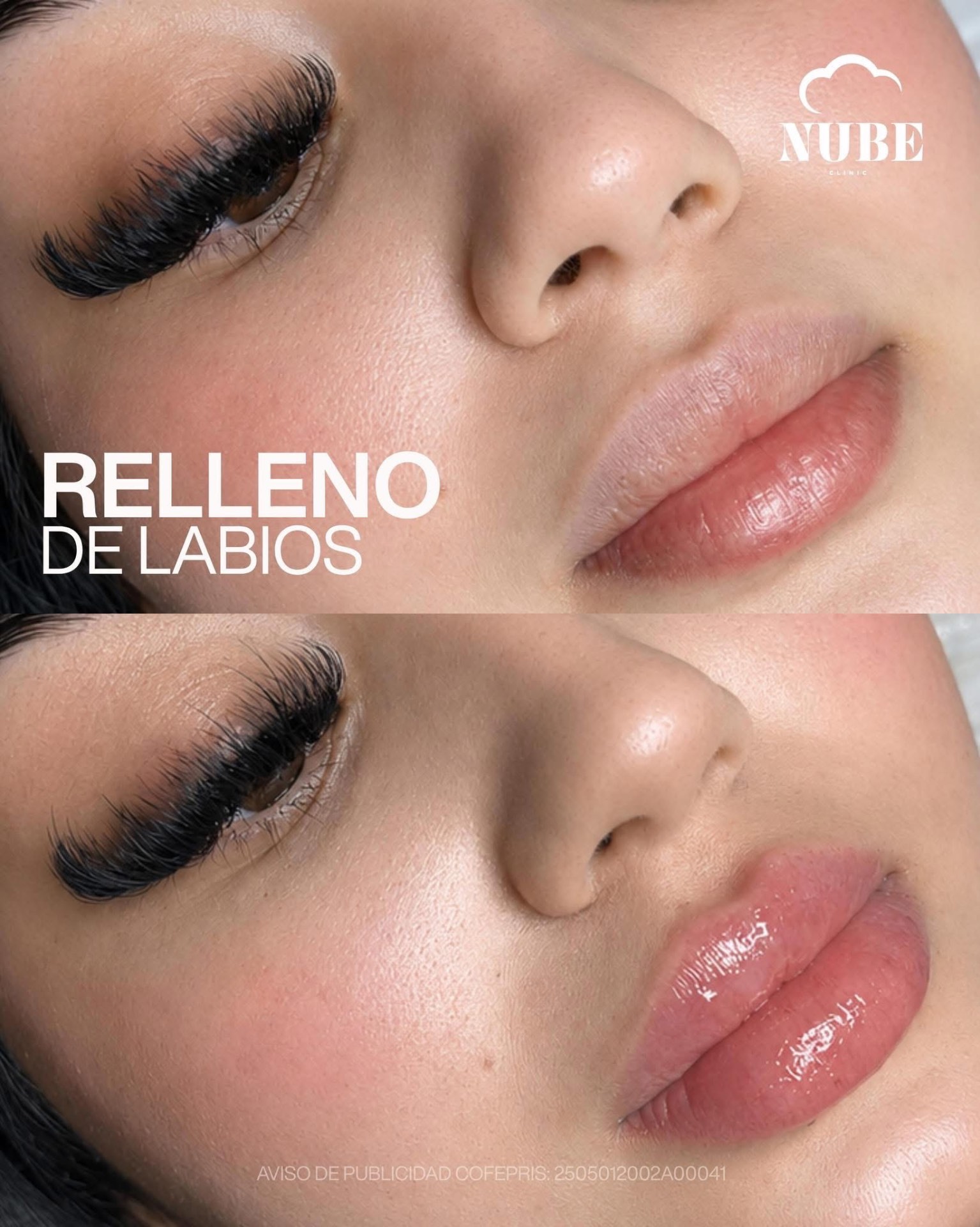 Antes y después de relleno de labios — Nube Clinic