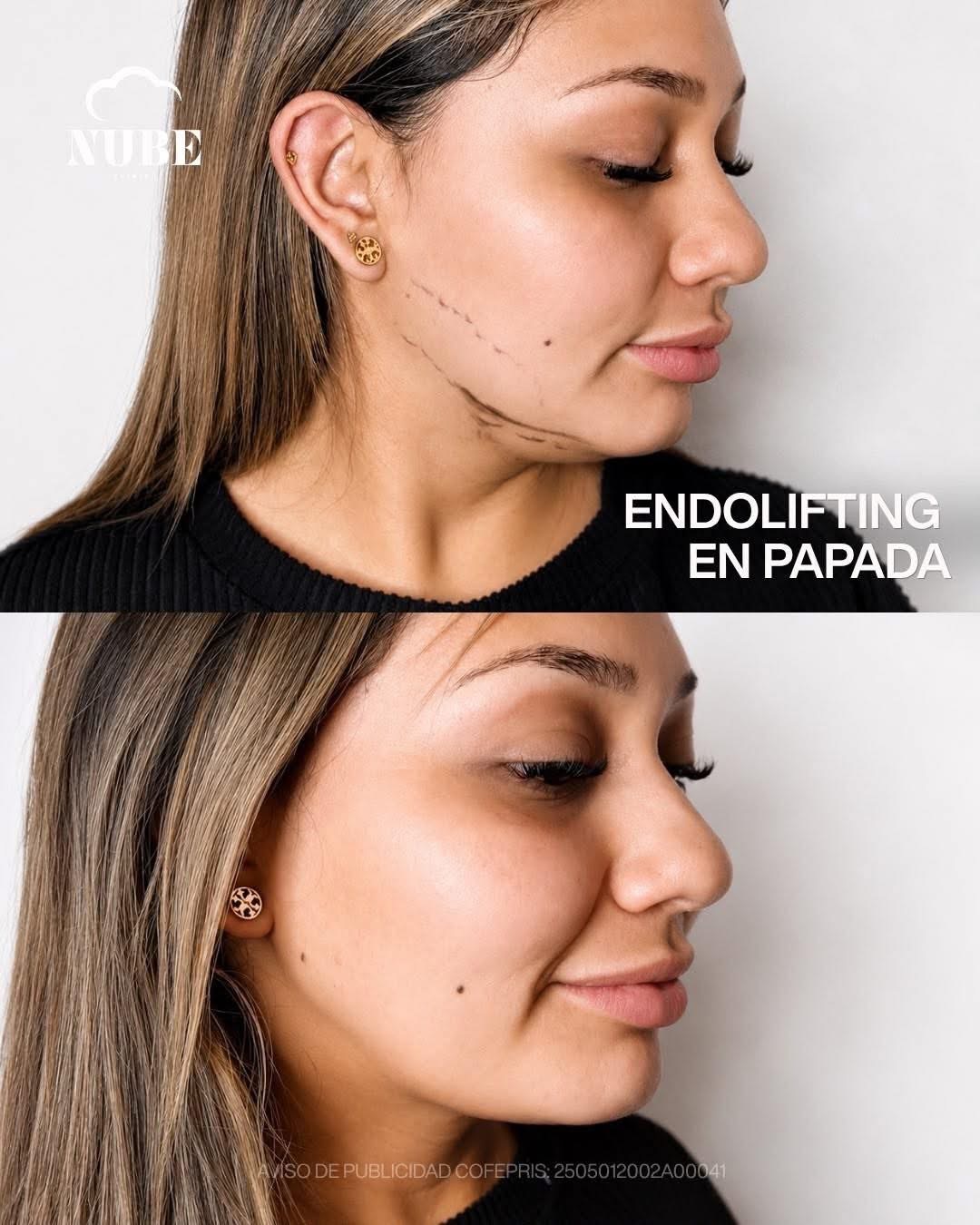 Antes y después de endolifting en papada — Nube Clinic