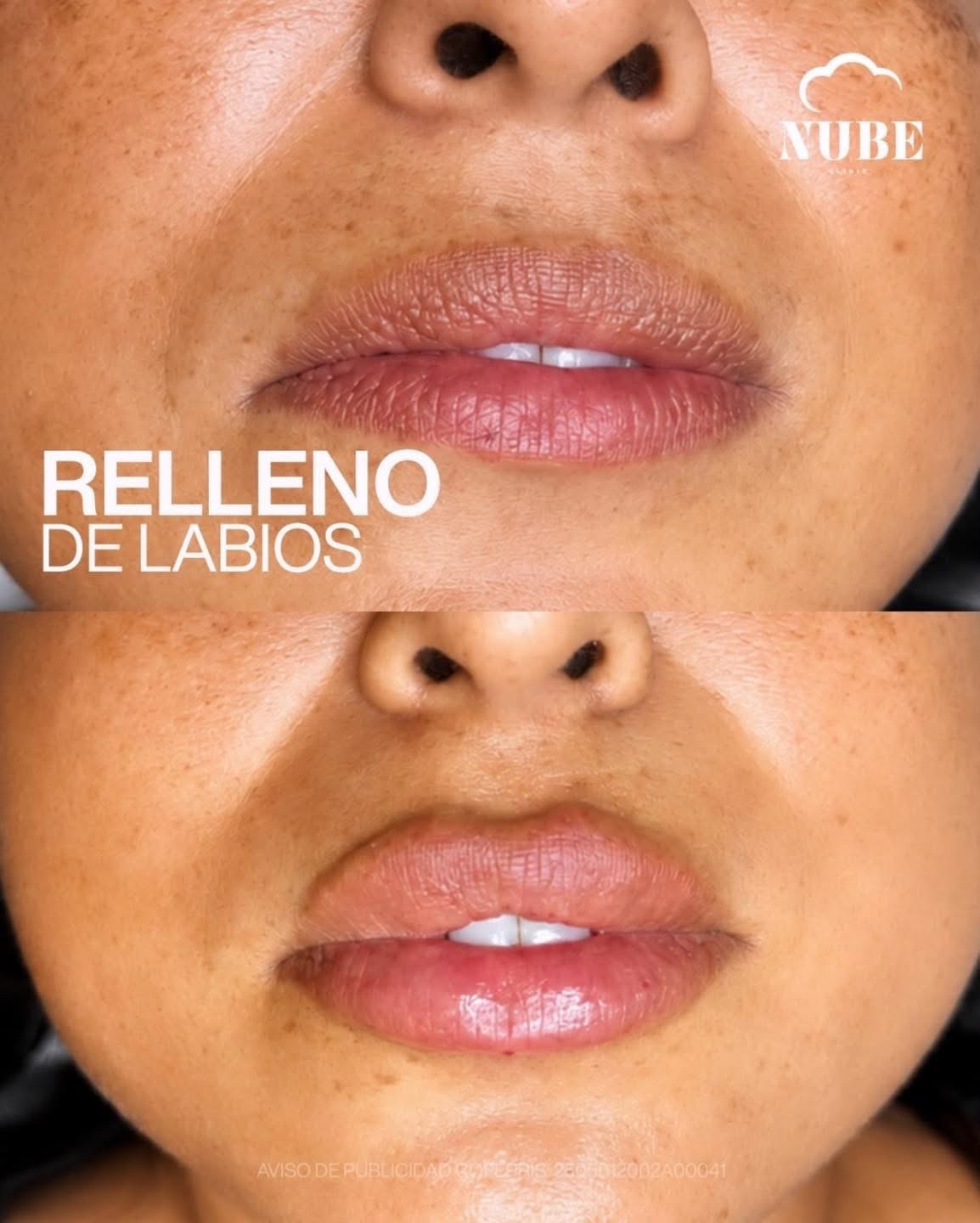 Antes y después de relleno de labios — Nube Clinic