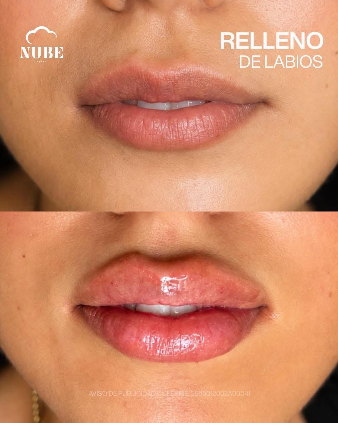 Antes y después de relleno de labios — Nube Clinic