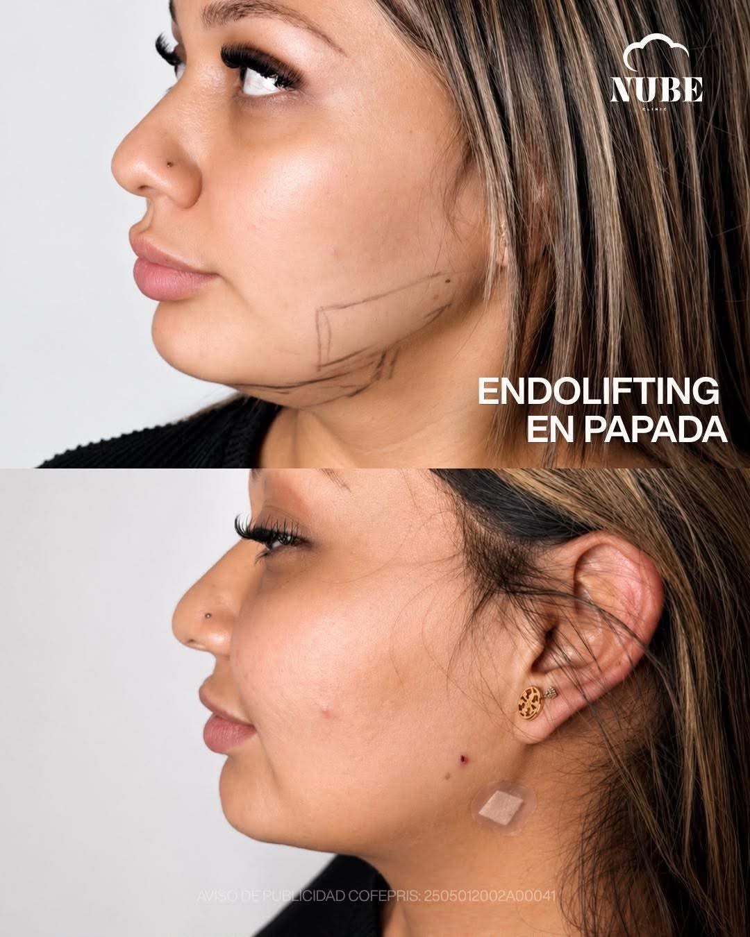 Antes y después de endolifting en papada — Nube Clinic