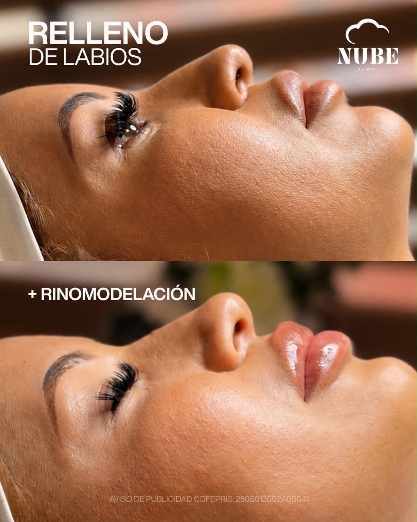 Antes y después de relleno de labios y rinomodelación — Nube Clinic