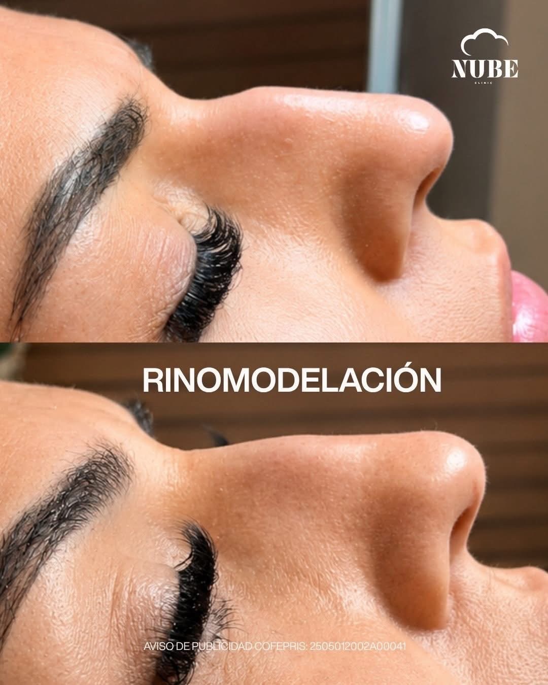 Antes y después de rinomodelación — Nube Clinic