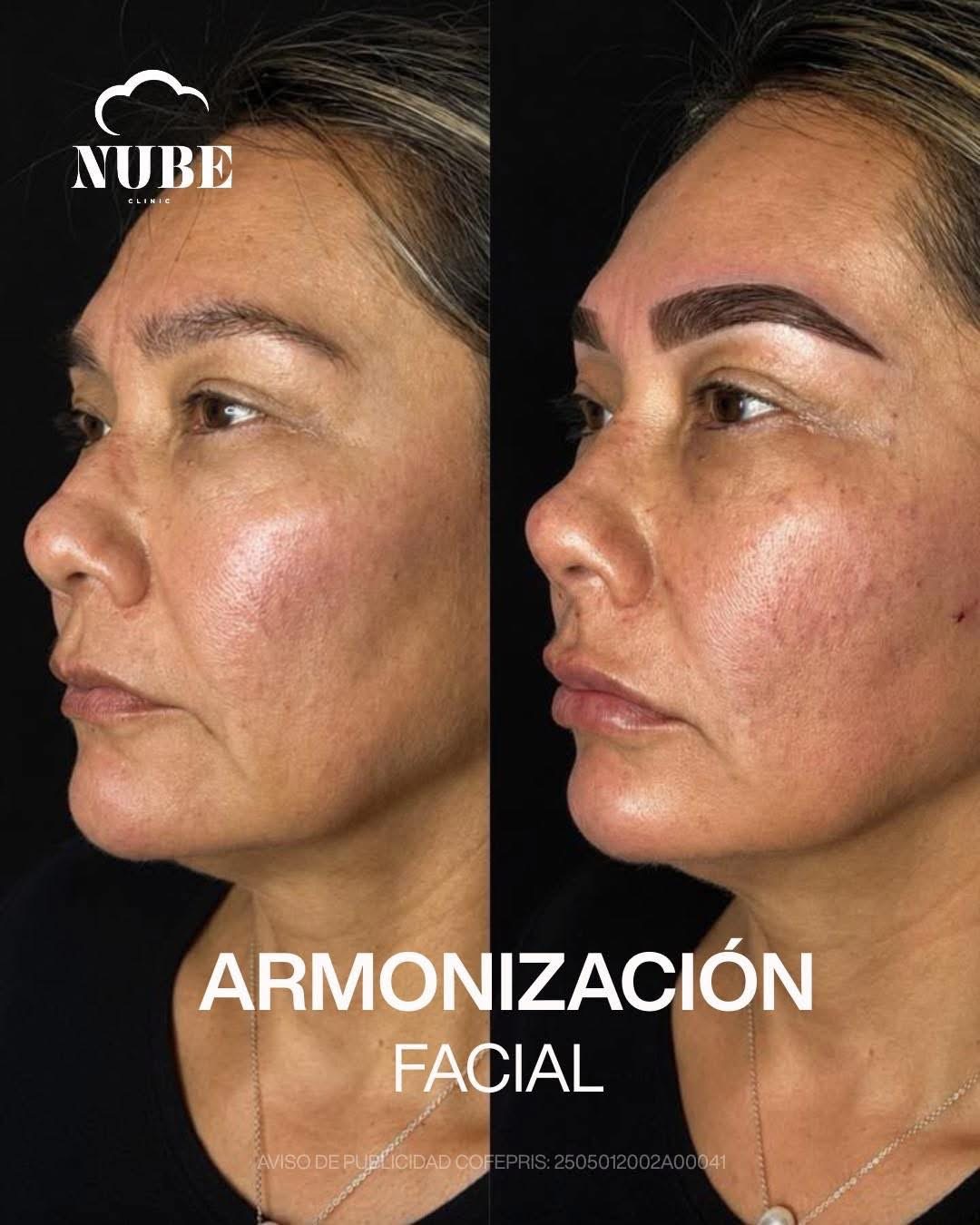 Antes y después de armonización facial — Nube Clinic