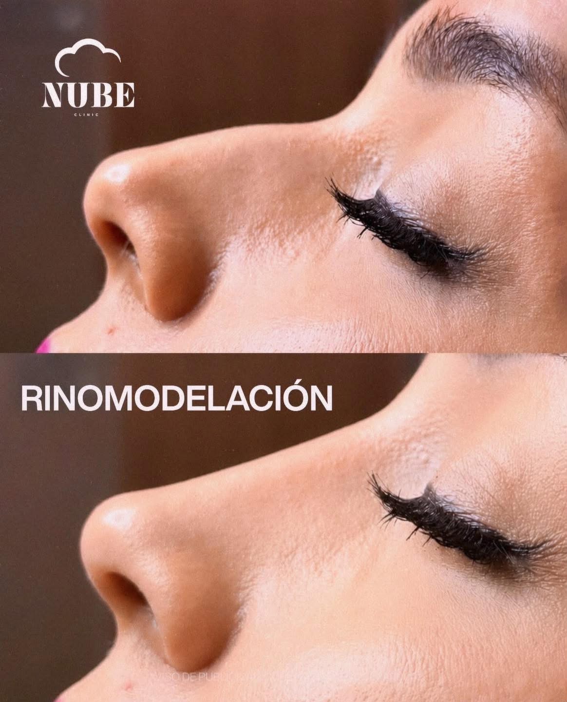 Antes y después de rinomodelación — Nube Clinic