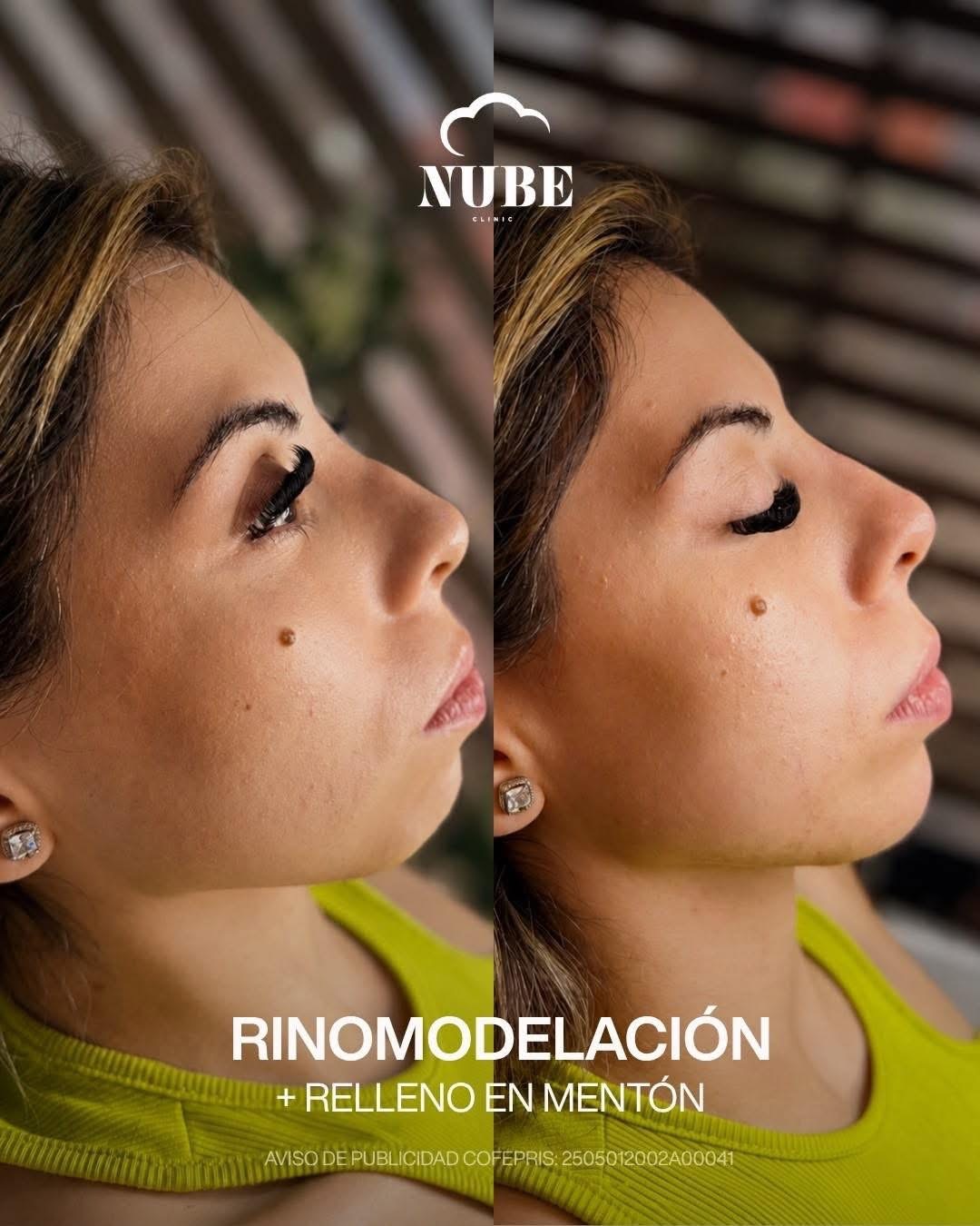 Antes y después de rinomodelación y relleno de mentón — Nube Clinic